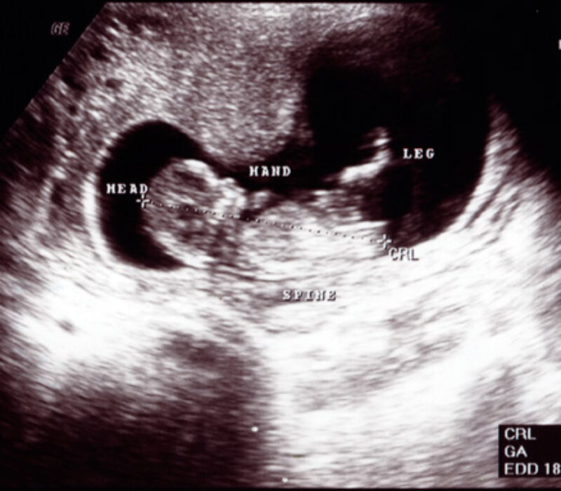 Innspill om tidlig ultralyd i svangerskapet