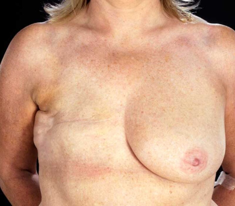 Brystkreft: Hvorfor blir ikke alle med kreftgener syke?