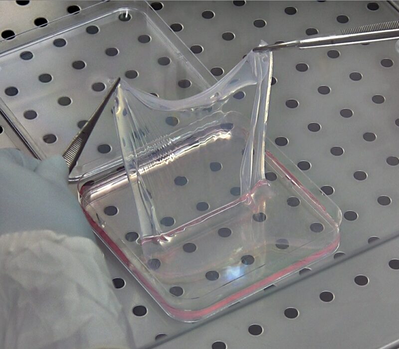 I GENialt: Sommerfuglbarna – nytt håp med genterapi